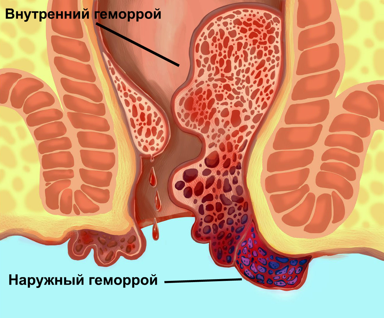 кровоточит после стула из заднего прохода