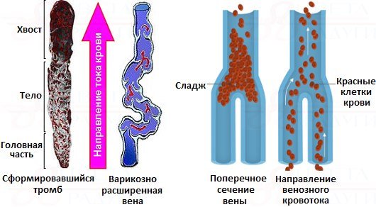 Сладж это. Сладж феномен. Сладж феномен эритроцитов. Сладжирование эритроцитов.