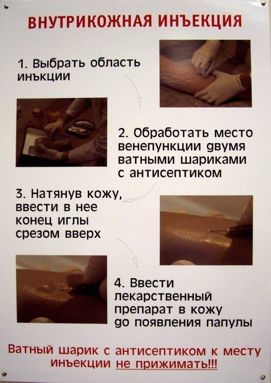 Внутрикожная инъекция алгоритм. Внутрикожная инъекция техника. Техники введения инъекций. Методика выполнения внутривенных и внутримышечных инъекций. Внутрикожная инъекция алгоритм выполнения.