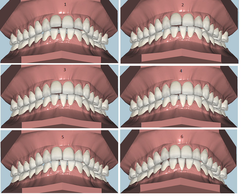 Включенный дефект зубного ряда. Рвные зубы после брекит. Схема зубов человека с нумерацией стоматологии. Зубы по номерам в стоматологии у детей схема. Зубного ряда с помощью.