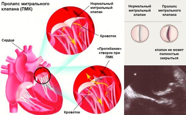 Уплотнение задней стенки митрального клапана