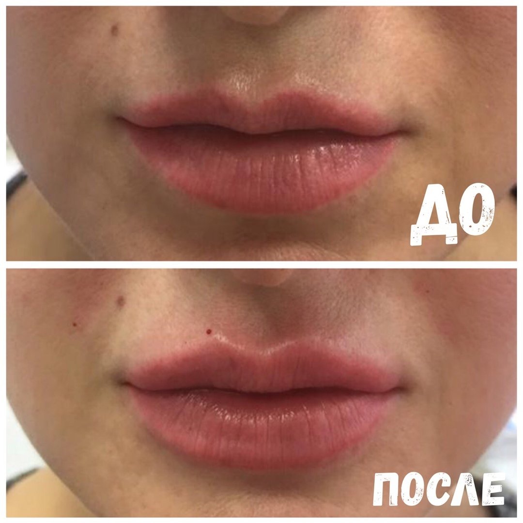 Контурная пластика губ филлерами гиалуроновой кислоты. Больно колоть губы форум. Больно колоть губы. Инъекционная контурная пластика губ. Хейлопластика кессельринг.