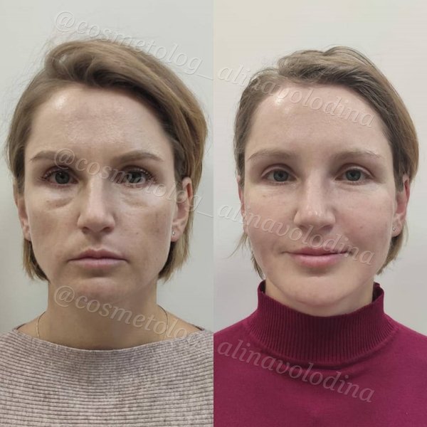 Женщина 35 лет. Морщины на лице. Кожа 38 лет. Кожа 38 лет. Кожа 38 лет.