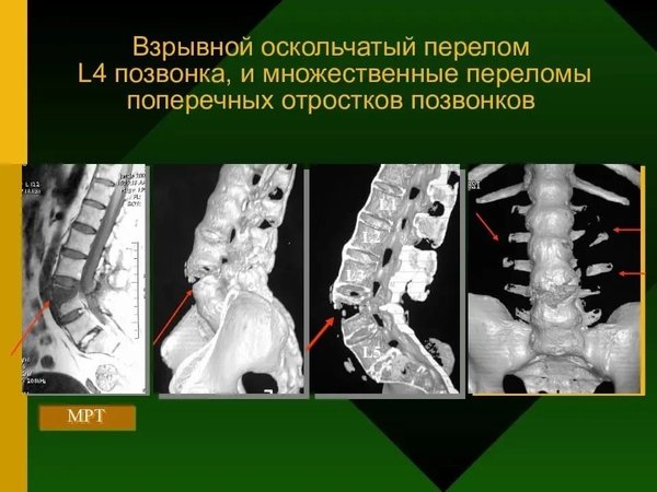 Лучевая диагностика позвоночник презентация